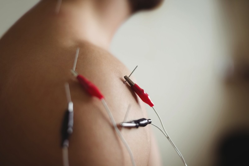 close-up-of-patient-getting-electro-dry-needling