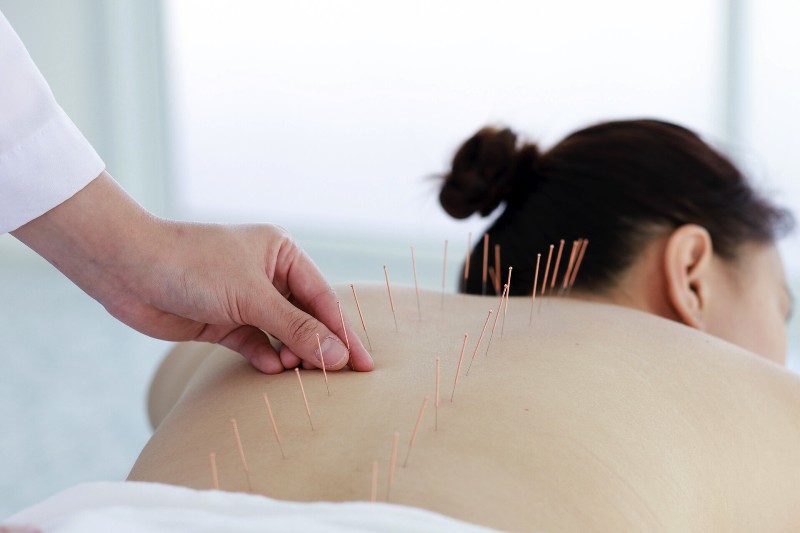 hand-of-doctor-performing-acupuncture-therapy-asian-female-undergoing-acupuncture-treatment-with-a-line-of-fine-needles-inserted-into-the-her-body-skin-in-clinic-hospital
